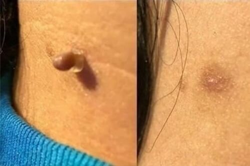 Katie S. skin tag result