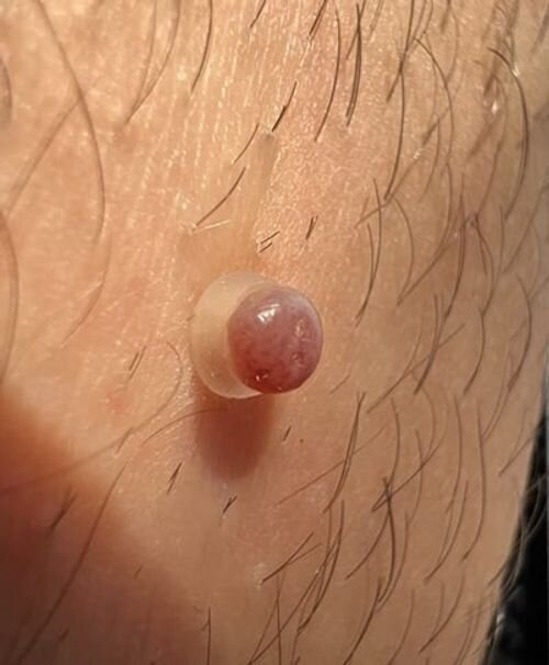Michelle T. skin tag result