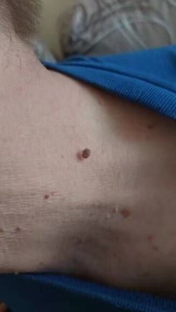 Tiffany W. skin tag result