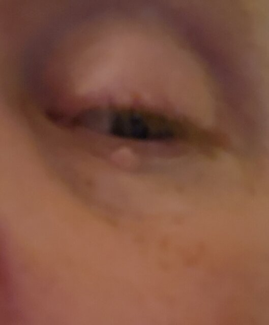 Brian skin tag result