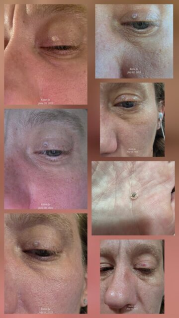 Katie-Jo skin tag result