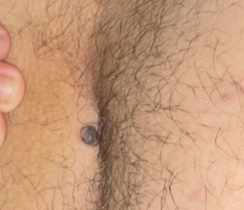 Leonardo skin tag result