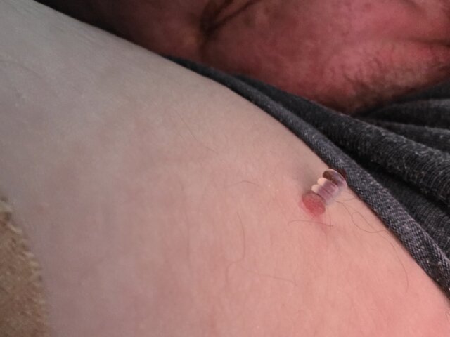 Dave skin tag result